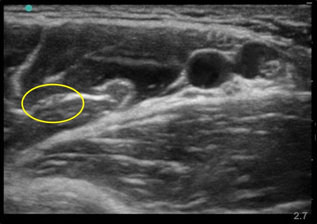 Anatomie échographique : Nerf musculocutané