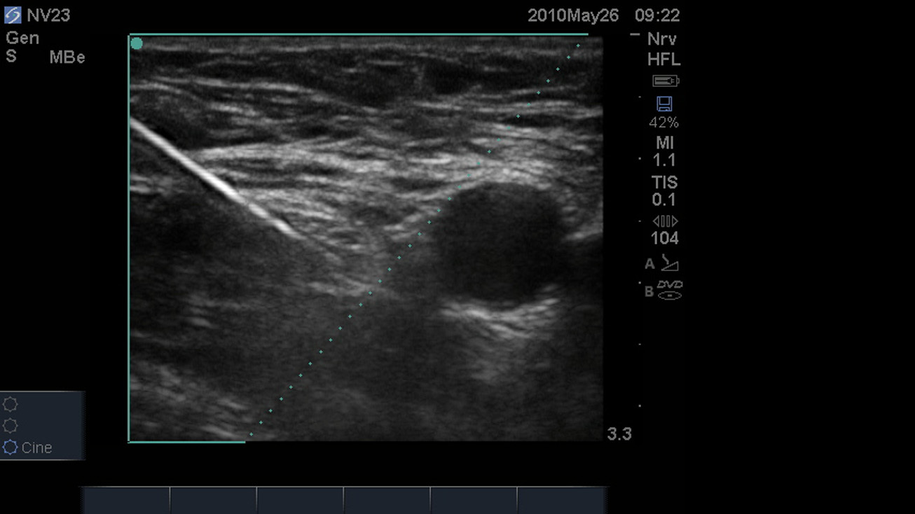 SonoMBe On - Steep Femoral Nerve 3cm