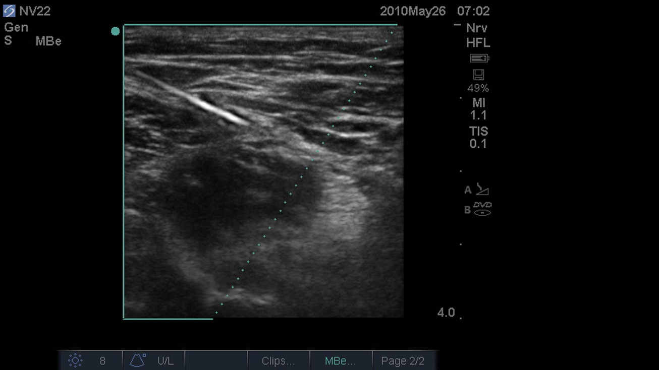 SonoMBe On - Steep Femoral Nerve 4cm